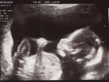 What is a Fetal Heart Scan? - Leeds Congenital Hearts