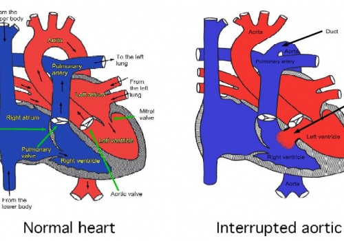 interrupted aortic arch vsd genetic