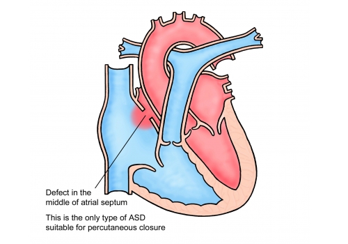 atrial septal defect types