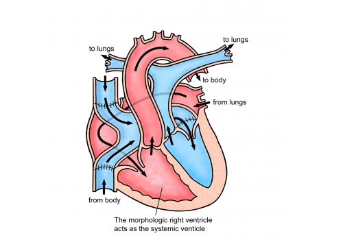 Transposition of the Great Arteries